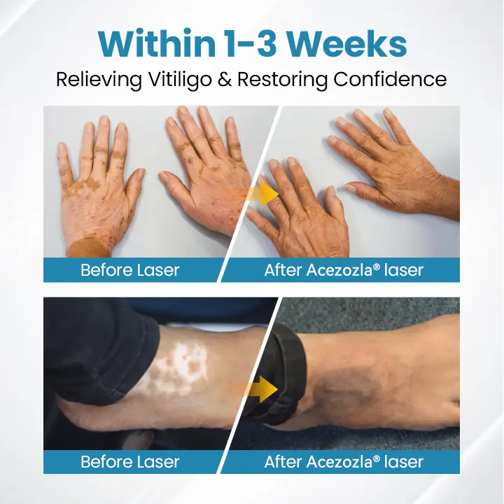 Appareil de thérapie contre le vitiligo Acezozla® DermaBeam - Image 4