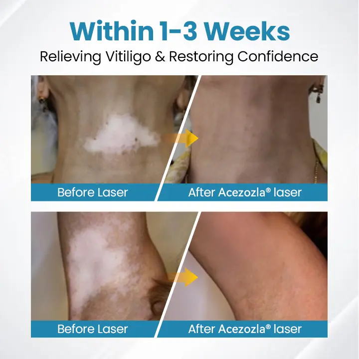Appareil de thérapie contre le vitiligo Acezozla® DermaBeam - Image 5