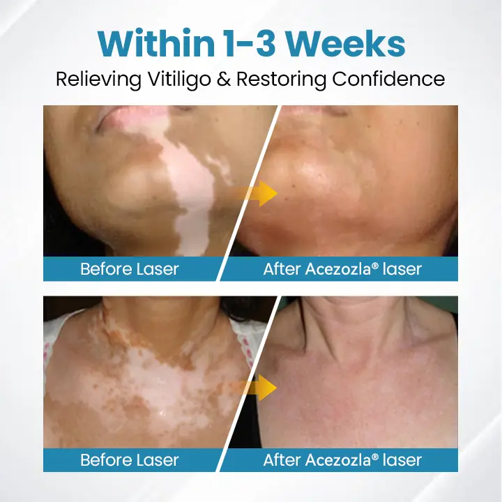 Appareil de thérapie contre le vitiligo Acezozla® DermaBeam - Image 7